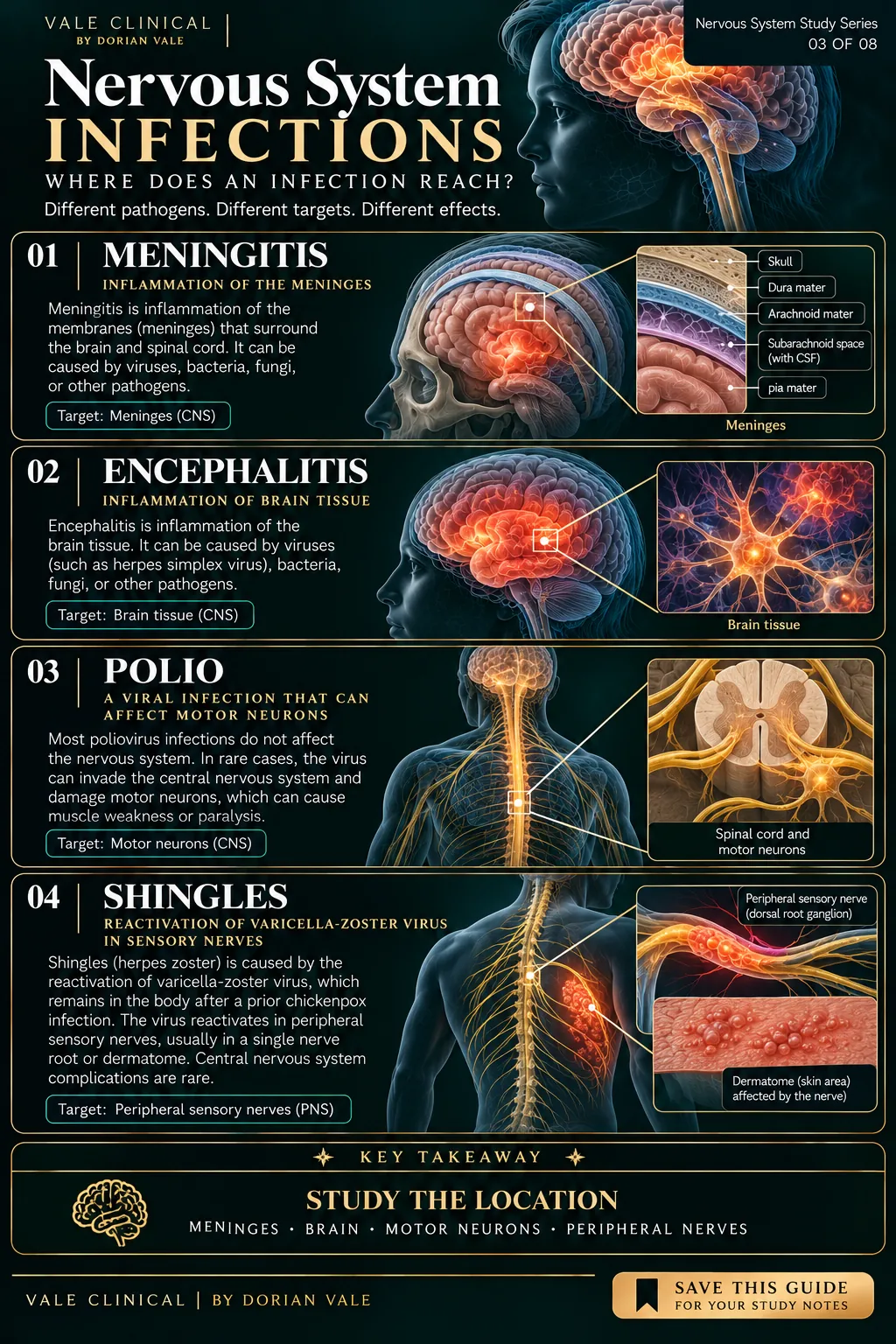 Vale Clinical infection infographic comparing meningitis of the meninges, encephalitis of brain tissue, rare neurological complications of polio and shingles of peripheral sensory nerves.